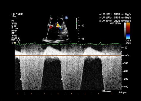 lv dp/dt|left ventricular diastolic function indeterminate.